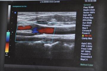 échographie de la carotide